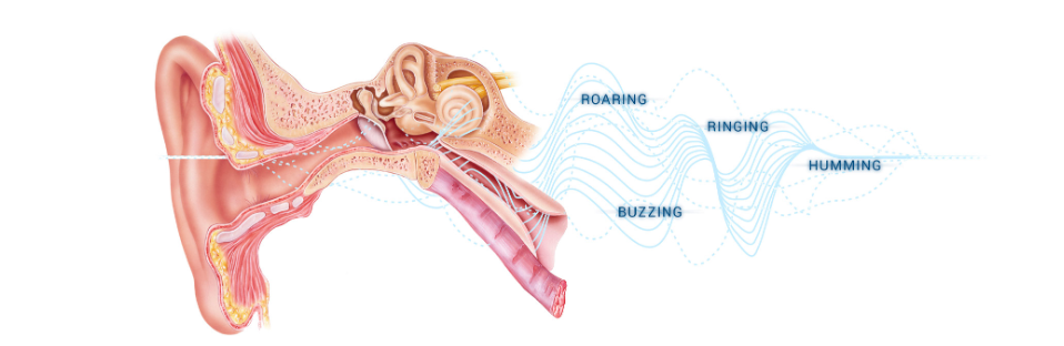 5ff8b476471a9933a7eedf03_screen20shot202021-01-0820at201-35-0420pm phantom perception of tinnitus